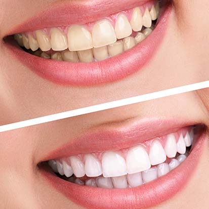 Calgary Teeth Whitening | Concept Dentistry | SE Calgary Dentist