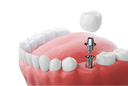 dental implants se calgary