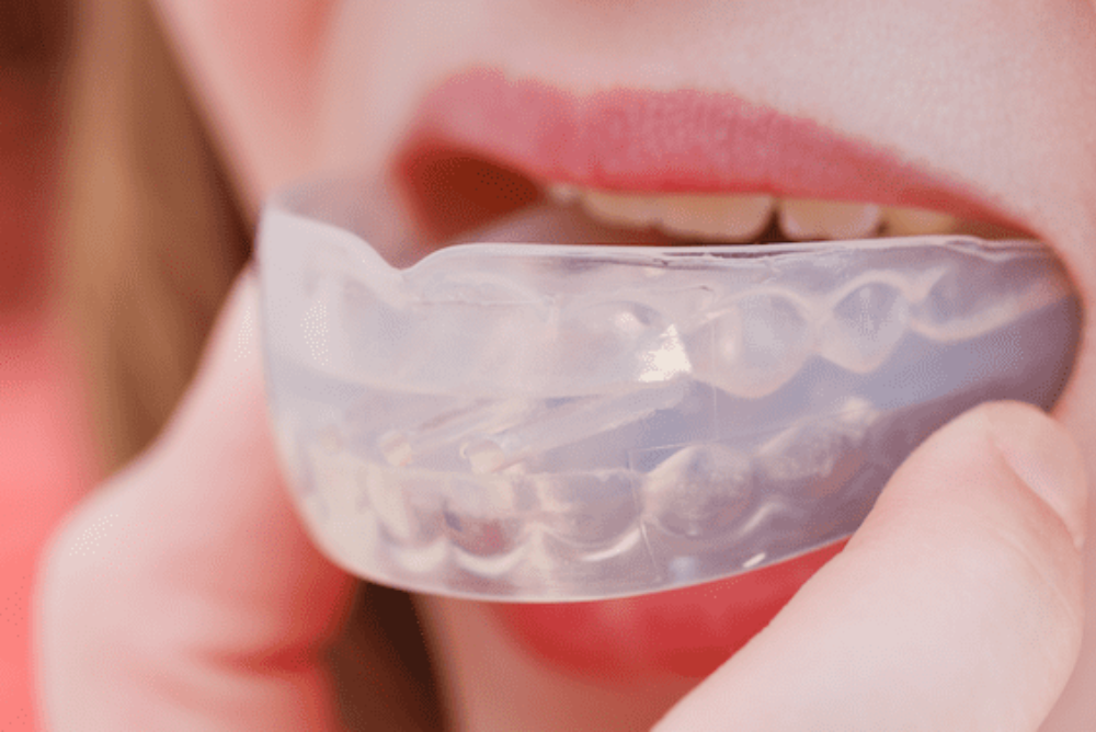 sports mouthguards se calgary