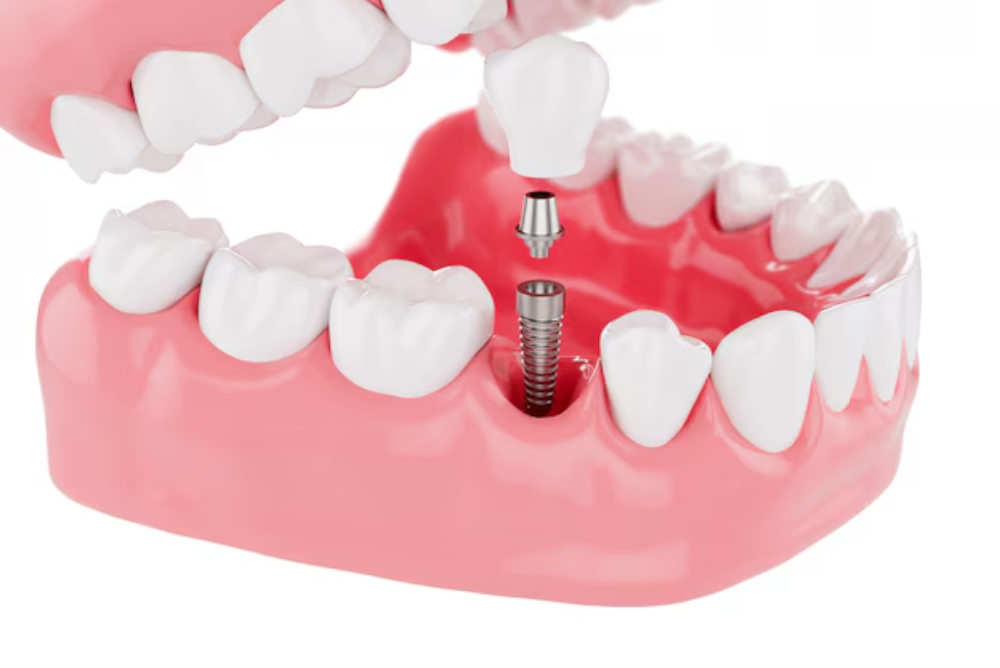 dental implants near me