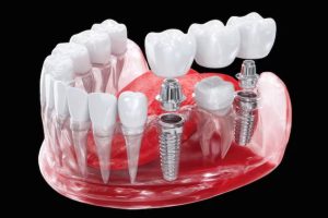 3d human jaw icon with two dental implants supporting crown bridge
