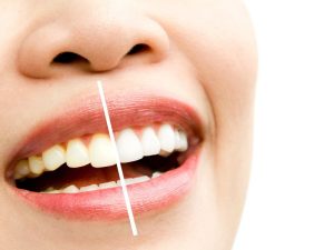 how long does teeth whitening last and how to maintain results